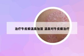治療牛皮癬溫泉加盟 溫泉對牛皮廨治療