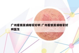 廣州看銀屑病哪家好啊 廣州看銀屑病哪家好啊醫(yī)生