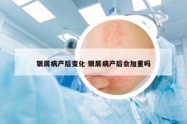 銀屑病產(chǎn)后變化 銀屑病產(chǎn)后會加重嗎