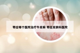 棗莊哪個醫(yī)院治療牛皮癬 棗莊皮膚科醫(yī)院