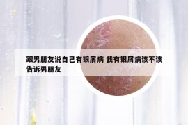 跟男朋友說自己有銀屑病 我有銀屑病該不該告訴男朋友