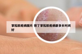掌拓膿皰病圖片 得了掌拓膿皰病都多長(zhǎng)時(shí)間好