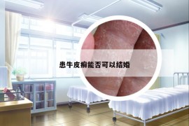 患牛皮癬能否可以結婚