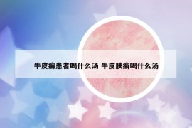 牛皮癬患者喝什么湯 牛皮膚癬喝什么湯