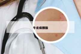 牛皮癬腰酸
