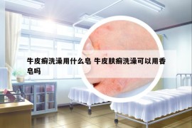牛皮癬洗澡用什么皂 牛皮膚癬洗澡可以用香皂嗎