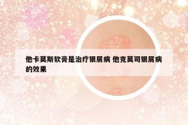 他卡莫斯軟膏是治療銀屑病 他克莫司銀屑病的效果