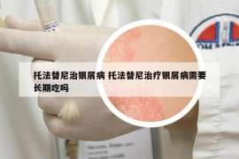 托法替尼治銀屑病 托法替尼治療銀屑病需要長(zhǎng)期吃嗎