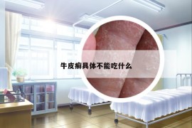 牛皮癬具體不能吃什么