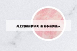 身上的癬會(huì)傳染嗎 癬會(huì)不會(huì)傳染人