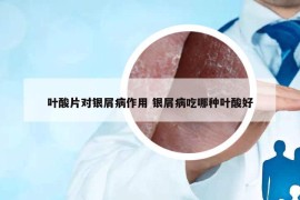葉酸片對(duì)銀屑病作用 銀屑病吃哪種葉酸好