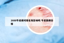 1688牛皮癬對(duì)排名有影響嗎 牛皮膚癬價(jià)格
