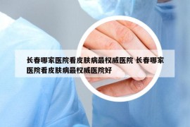 長(zhǎng)春哪家醫(yī)院看皮膚病最權(quán)威醫(yī)院 長(zhǎng)春哪家醫(yī)院看皮膚病最權(quán)威醫(yī)院好