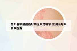 蘭州看銀屑病最好的醫(yī)院是哪家 蘭州治療銀屑病醫(yī)院