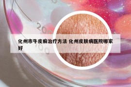 化州市牛皮癬治療方法 化州皮膚病醫(yī)院哪家好