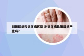 副銀屑病和銀屑病區(qū)別 副銀屑病比銀屑病嚴(yán)重嗎?