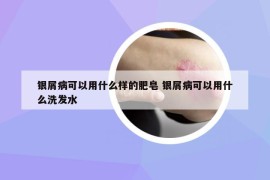 銀屑病可以用什么樣的肥皂 銀屑病可以用什么洗發(fā)水