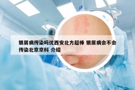 銀屑病傳染嗎優(yōu)西安北方超棒 銀屑病會不會傳染北京京科 介紹