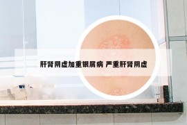 肝腎陰虛加重銀屑病 嚴(yán)重肝腎陰虛