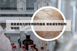 銀屑病有幾種生物制劑最新 銀屑病生物制劑哪四種