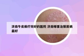 濟(jì)南牛皮癬療效好的醫(yī)院 濟(jì)南哪里治銀屑病最好