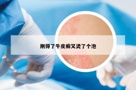 剛得了牛皮癬又燙了個泡
