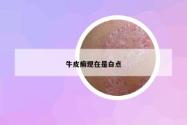 牛皮癬現(xiàn)在是白點