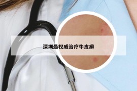 深圳最權(quán)威治療牛皮癬