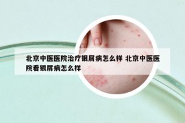 北京中醫(yī)醫(yī)院治療銀屑病怎么樣 北京中醫(yī)醫(yī)院看銀屑病怎么樣