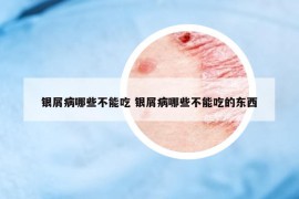 銀屑病哪些不能吃 銀屑病哪些不能吃的東西