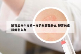 腳背出來牛皮癬一樣的東西是什么 腳背長皮膚癬怎么辦