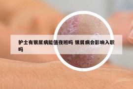 護(hù)士有銀屑病能值夜班嗎 銀屑病會影響入職嗎