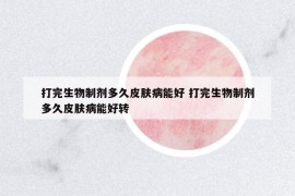 打完生物制劑多久皮膚病能好 打完生物制劑多久皮膚病能好轉(zhuǎn)