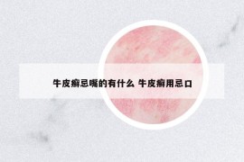 牛皮癬忌嘴的有什么 牛皮癬用忌口