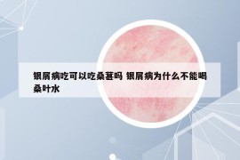 銀屑病吃可以吃桑葚嗎 銀屑病為什么不能喝桑葉水