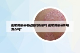 副銀屑病會引起別的疾病嗎 副銀屑病會影響壽命嗎?