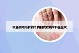 銀屑病揭陽那家好 揭陽皮膚病專科醫(yī)醫(yī)院