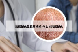 按壓褪色是銀屑病嗎 什么叫按壓褪色