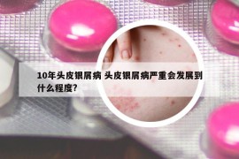 10年頭皮銀屑病 頭皮銀屑病嚴(yán)重會發(fā)展到什么程度?