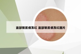 面部銀屑病發(fā)紅 面部銀屑病發(fā)紅圖片