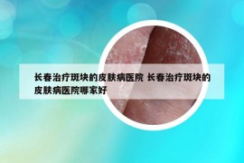 長春治療斑塊的皮膚病醫(yī)院 長春治療斑塊的皮膚病醫(yī)院哪家好