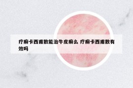 療癬卡西甫散能治牛皮癬么 療癬卡西甫散有效嗎
