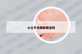 小兒牛皮癬能根治嗎