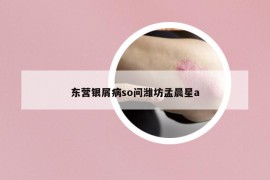 東營銀屑病so問濰坊孟晨星a