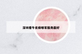 深圳看牛皮癬哪家服務(wù)最好