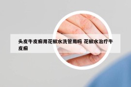 頭皮牛皮癬用花椒水洗管用嗎 花椒水治療牛皮癬