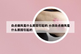 白點癲風是什么原因引起的 小孩白點癲風是什么原因引起的