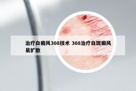 治療白癜風(fēng)308技術(shù) 308治療白斑癜風(fēng)易擴(kuò)散