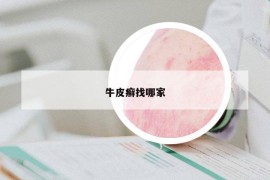 牛皮癬找哪家