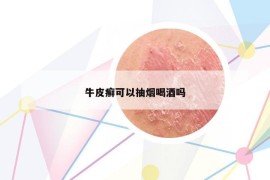 牛皮癬可以抽煙喝酒嗎